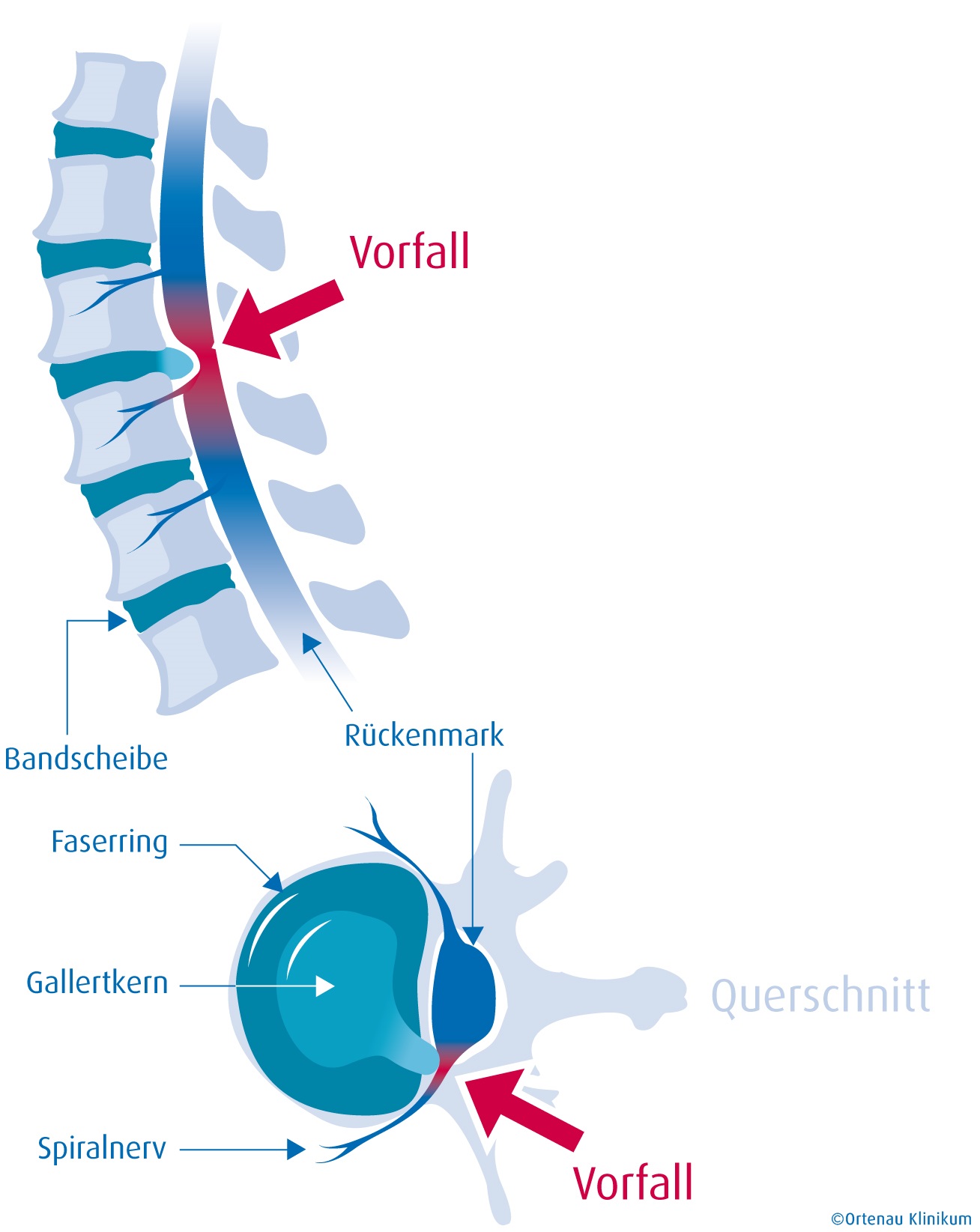 Ortenau_Klinikum_Bandscheibenvorfall